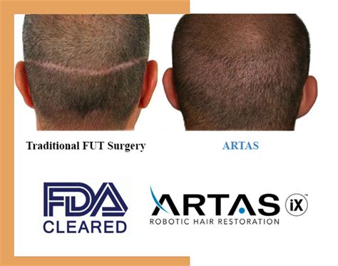 surgical hair restoration st louis mo|Hair Restoration St. Louis .